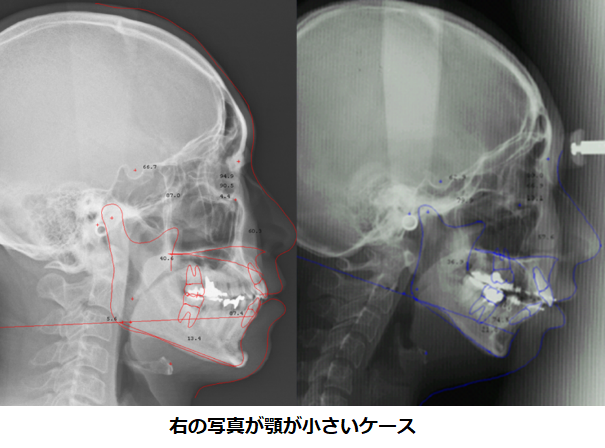 顎レントゲン